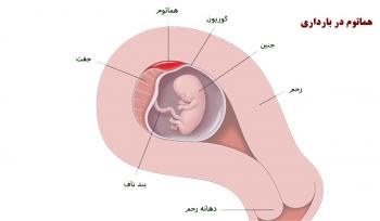 هماتوم بارداری چگونه جذب می شود؟